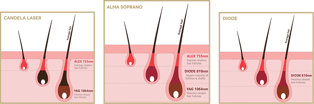 Triple Wavelength Laser Hair Removal That Works for Everyone