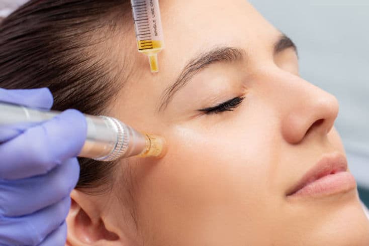 Elevate Your Skin's Renewal: Exploring Microneedling & Radiofrequency