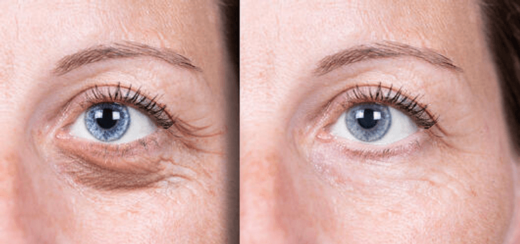 Under Eye Bags and What Is Causing Them